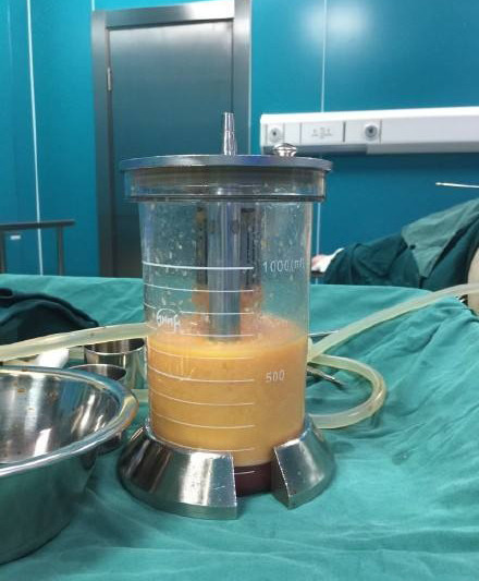 小腿粗怎么改善粗腿,小腿太粗怎么办