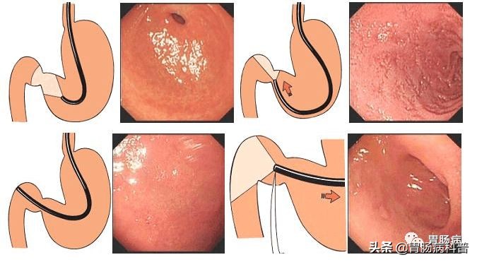 北大肿瘤医院院长沈琳：哪些人需要做胃镜？该做的人千万别犹豫