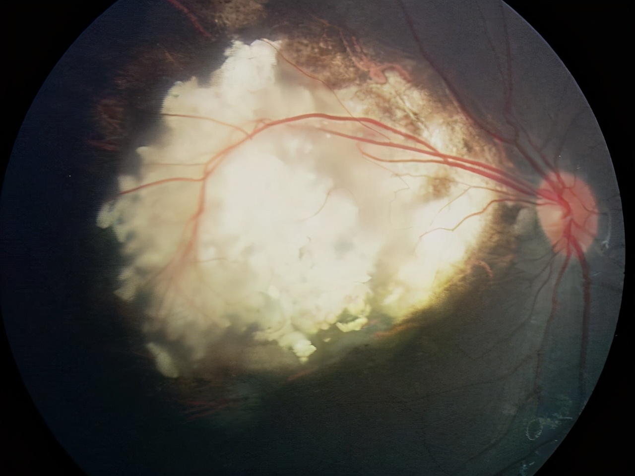 视网膜母细胞瘤是癌症吗,视网膜母细胞瘤为一种恶性肿瘤