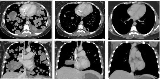 70种抗癌药新特效药,十大抗癌新药治疗癌症