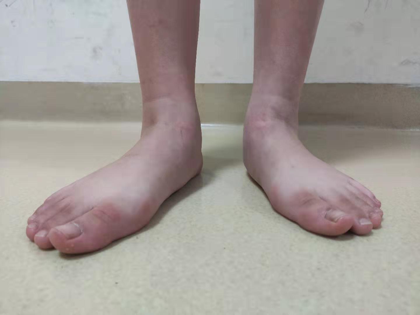 小腿肚酸胀是缺钙吗,小腿酸胀与静脉曲张有关系吗