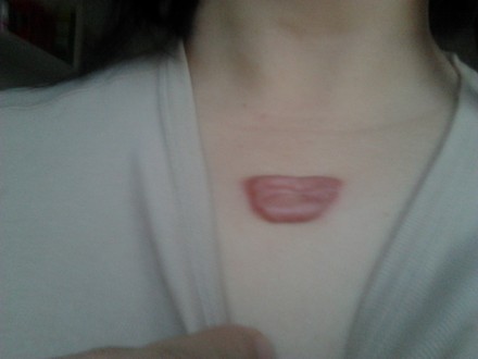 疤痕疙瘩淡化颜色的方法,氢醌乳膏能祛除疤痕红印吗