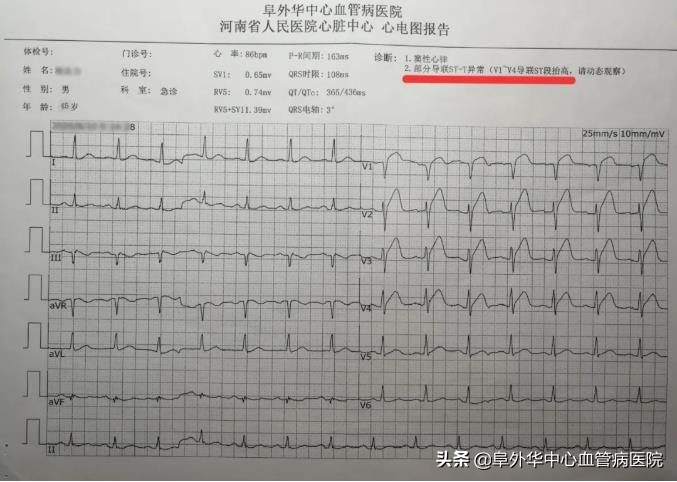 酒后心电图,酒后做心电图