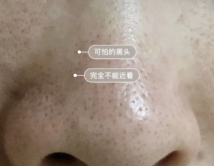 黑头闭口连根拔起,黑头粉刺连根拔起留坑