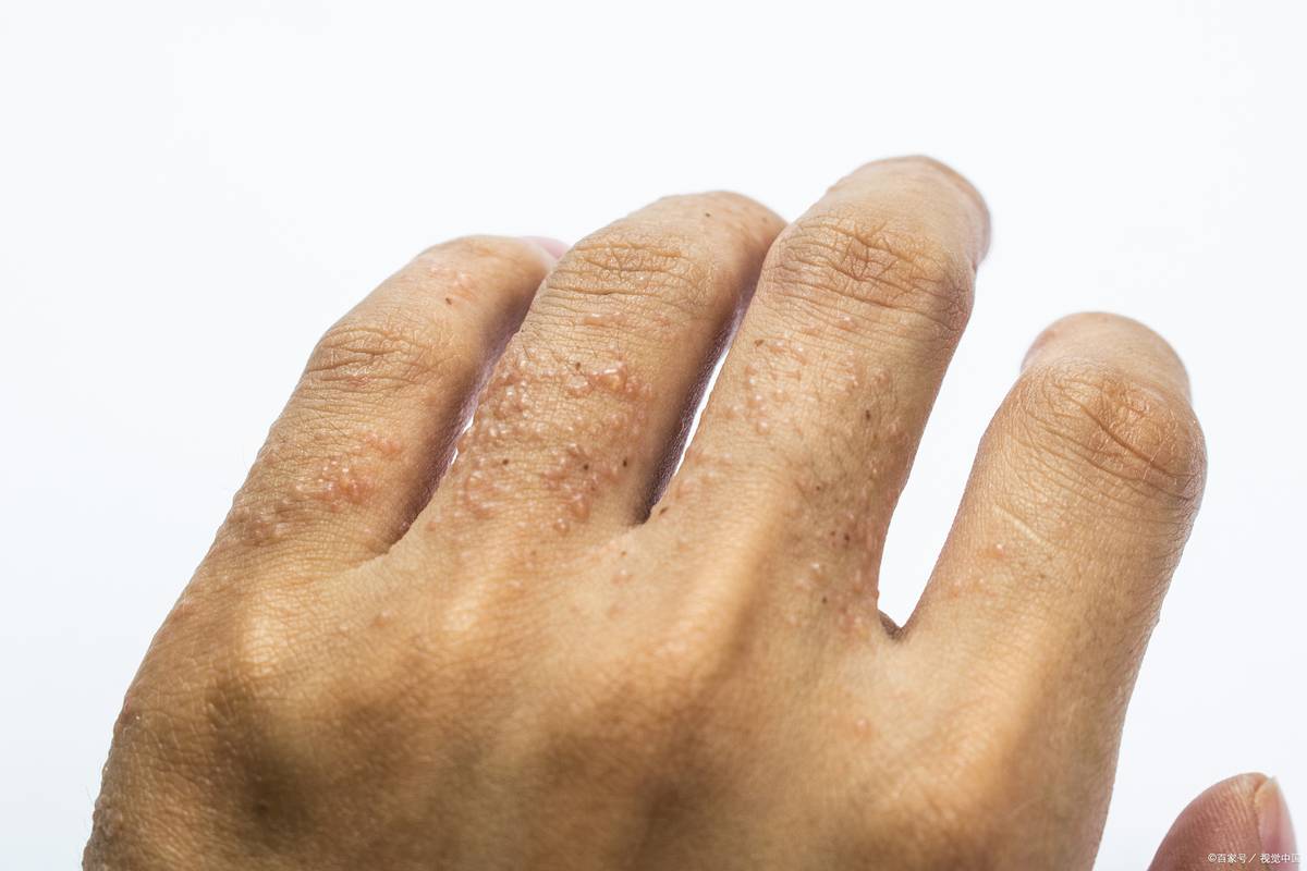 湿疹晚上很痒控制不住挠怎么办,湿疹越挠越痒还有大量红斑