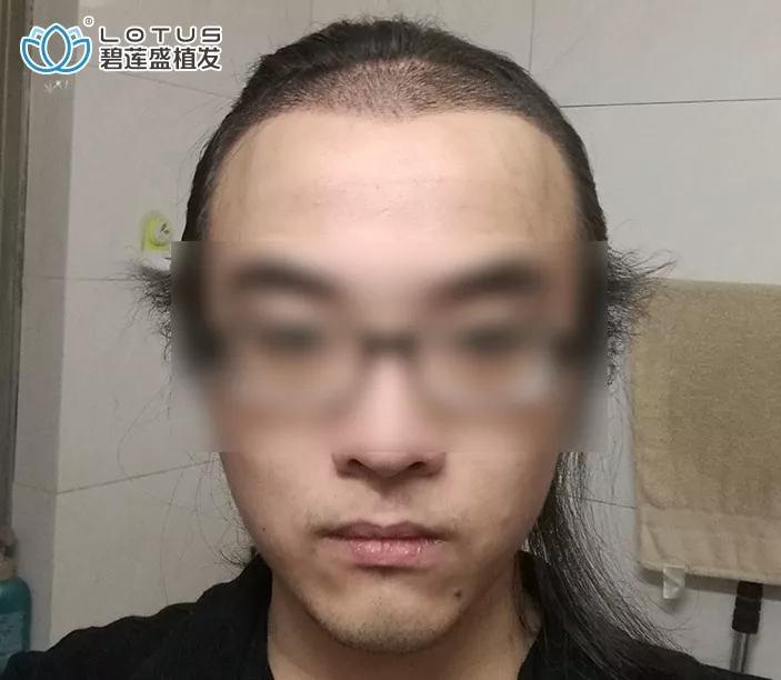 发际线后移额角大头发稀疏怎么办,额角发际线还能恢复吗