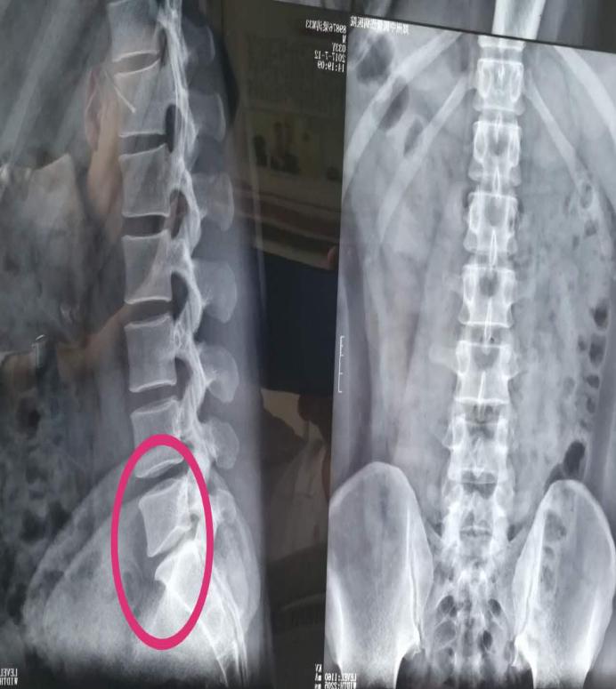 牵引动作治疗腰间盘突出,牵引法治疗腰间盘突出操作