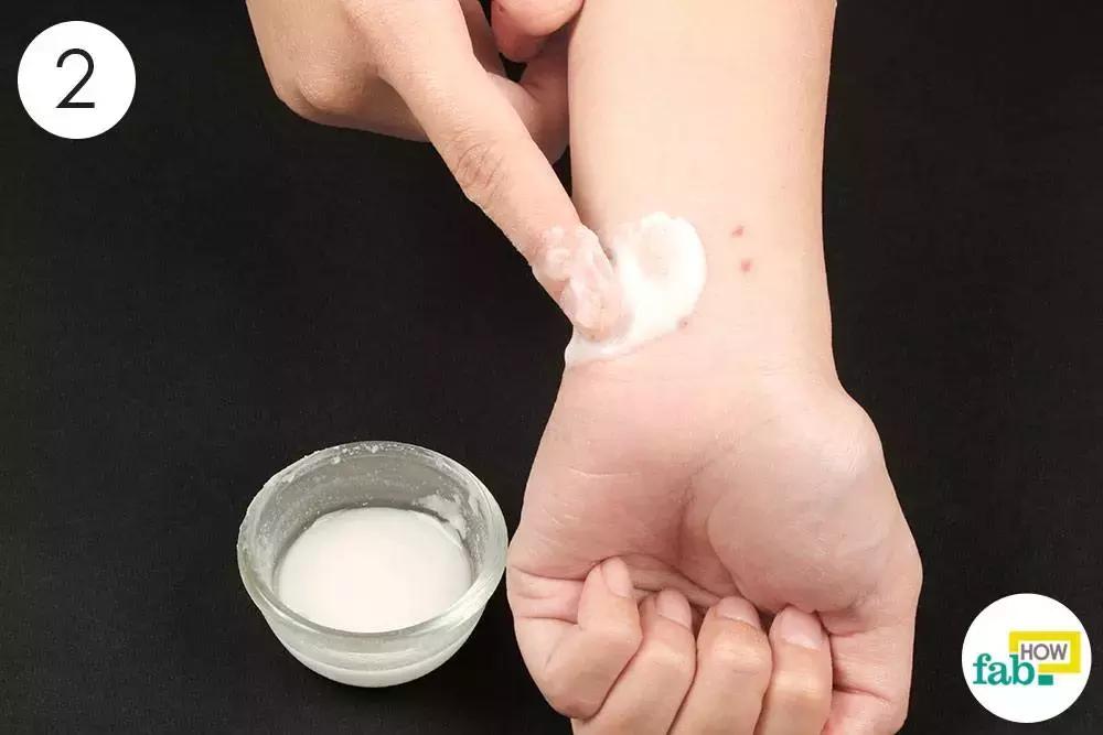 宝宝被蚊子咬了怎么消肿止痒最快,被蚊子咬了怎么止痒消肿用什么药