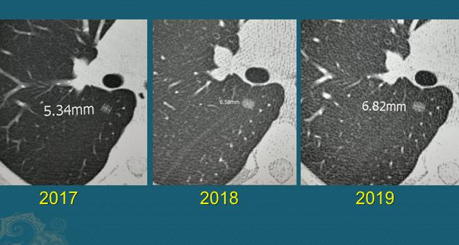 肺磨玻璃结节，3年增大2mm，该不该手术？