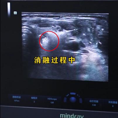 甲状腺微小癌消融术好还是切除好,甲状腺微小癌1期