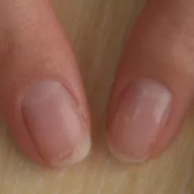 美甲会不会导致灰指甲,灰指甲脱甲液致癌