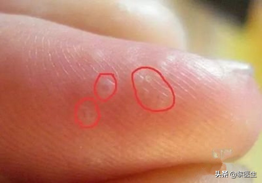 得了汗疱疹怎么办,得了汗疱疹用什么洗手