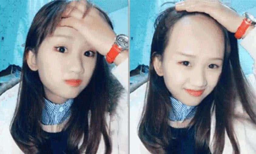 贝克汉姆怎么治疗脱发,贝克汉姆脱发的原因