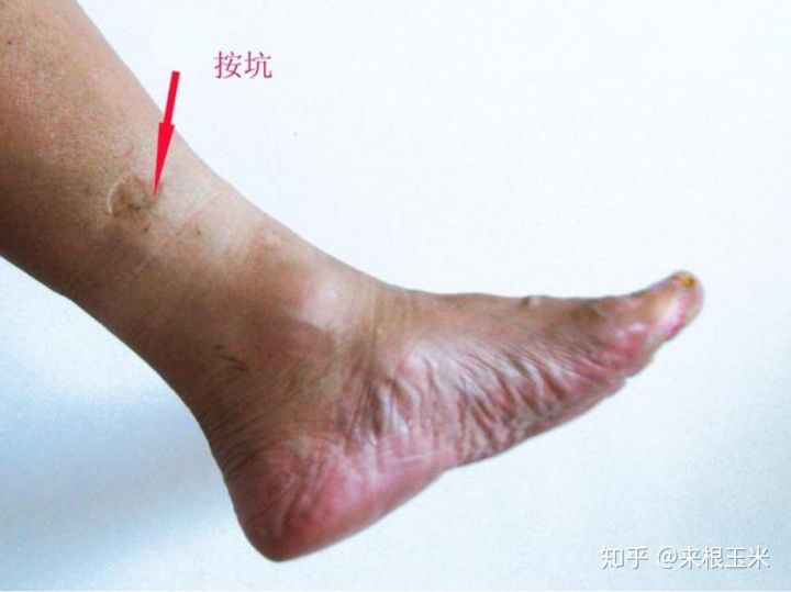 水肿腿加大象腿怎么瘦,大象腿赘肉多