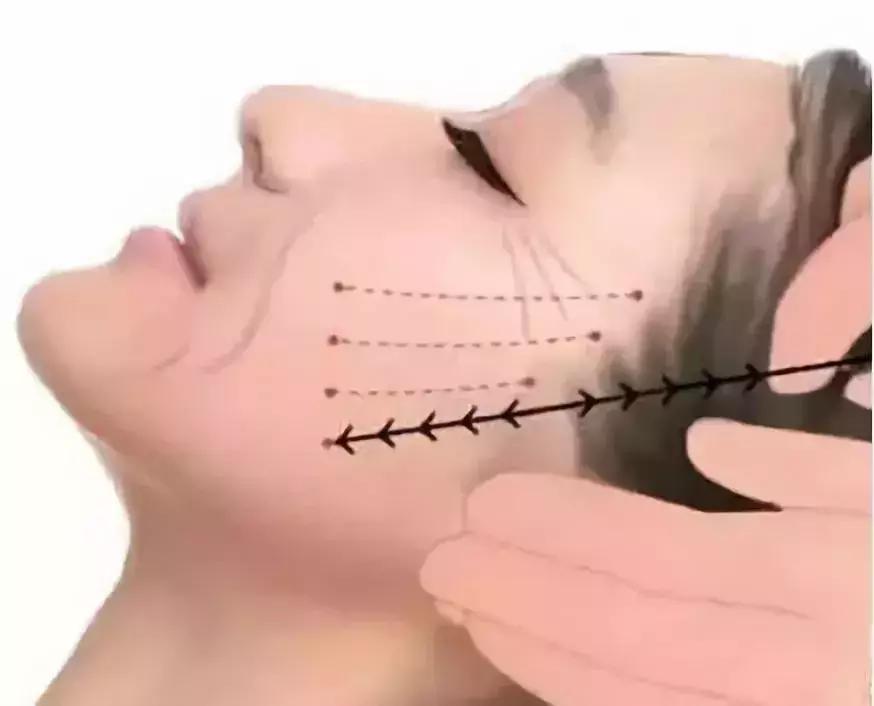 线雕5年后的变化图片,做了线雕以后的注意事项