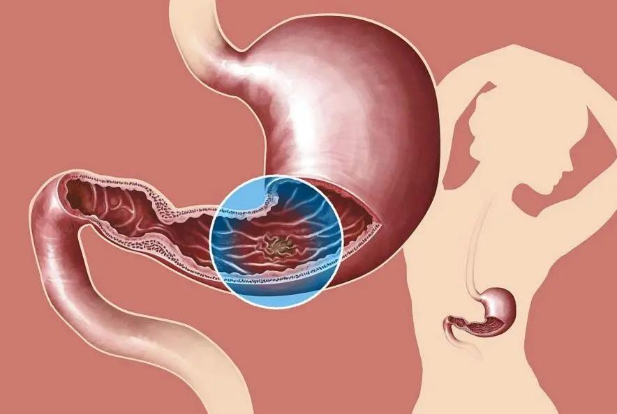 糜烂性胃炎真的是胃烂了嘛,糜烂性胃炎胃食道反流原因