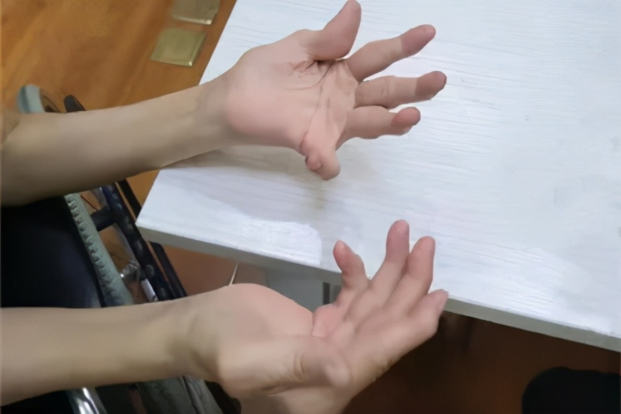 类风湿关节炎如何能把激素减停,治疗类风湿消除炎症的最佳办法