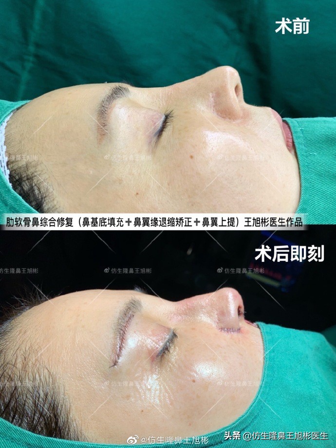 不想鼻子变得坑坑洼洼,不想整容想让鼻子挺起来