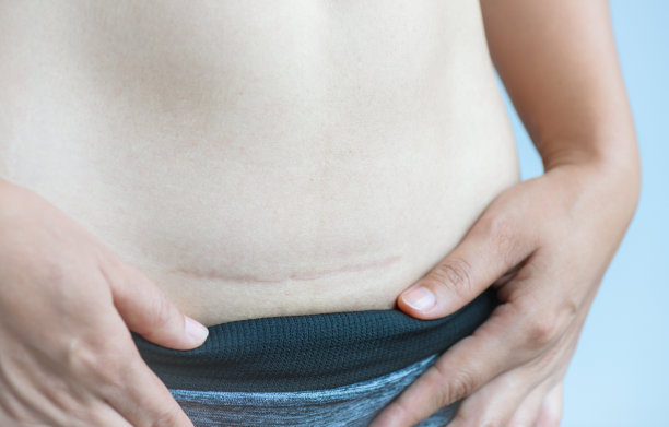 剖腹产疤痕怎么快速消除小妙招,一白遮百丑的调理方法