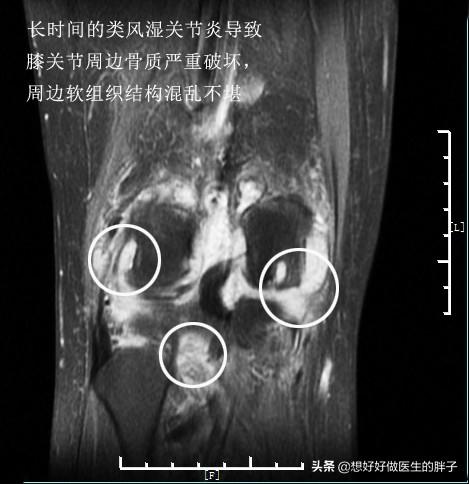 膝盖积水以后是热敷还是冷敷？真能解决问题吗？医生：可能都没用
