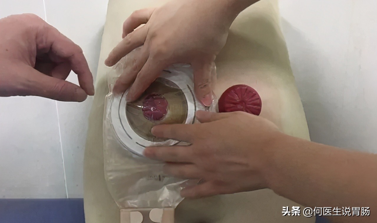 越来越多人因肠癌丧命,肛肠癌怎样缓解痛苦