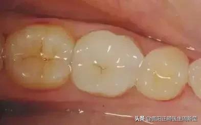 牙齿以前齐现在不齐是什么原因,牙齿排列整齐牙缝大前门牙凸