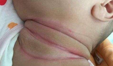 胖宝宝褶皱处红了怎么办,宝宝胖嘟嘟的脸就是好看