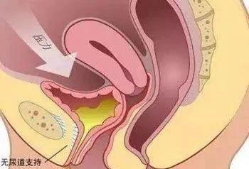 怎么判断自己是否有漏尿,科普漏尿原因