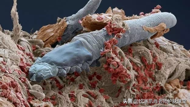 螨虫感染皮肤的症状如何去除,全身被螨虫咬怎么解决