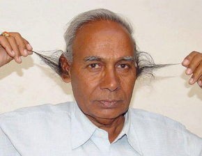 米诺地尔搽剂治疗脱发有副作用吗 (用米诺地尔所有人都会有副作用吗)