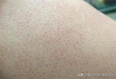 摆脱鸡皮肤的困扰,去鸡皮肤有效的方法真实测评