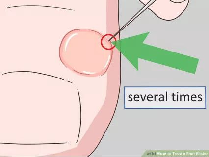 如何预防与处理比跑步膝痛还烦人的水泡？