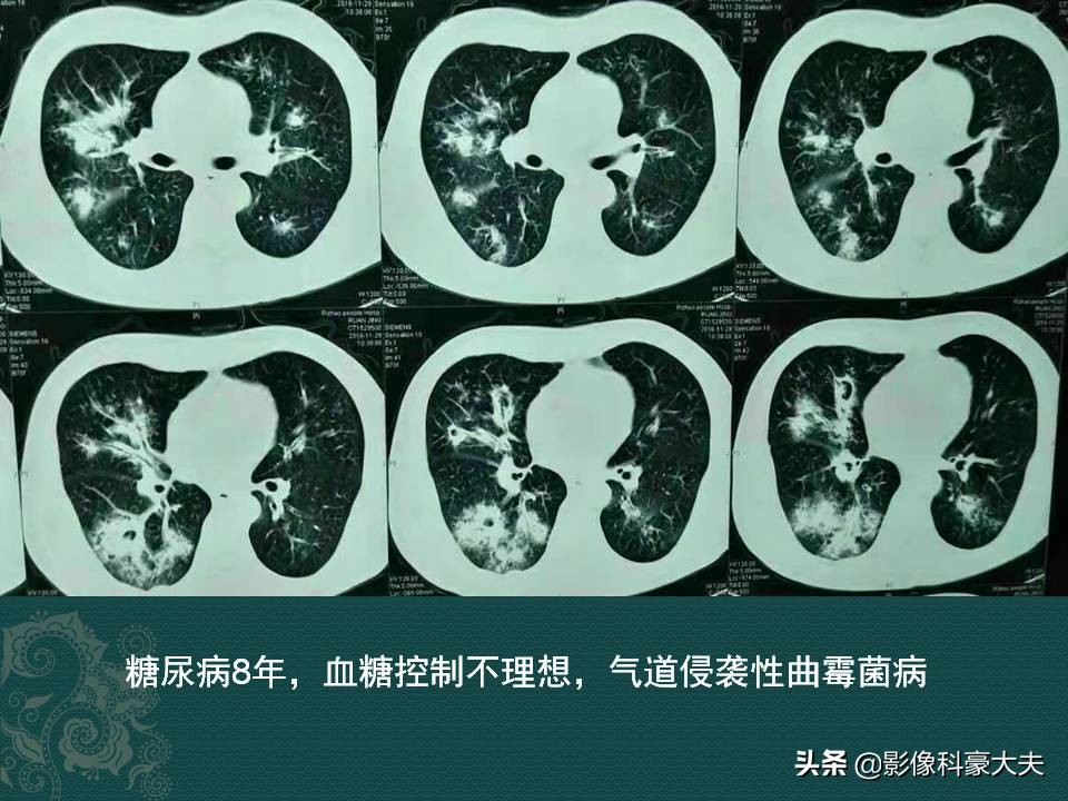 瀹濆鍙戠儳38.5鍙互涓嶅悆鑽悧,32宀佺硸灏跨梾瀹濆