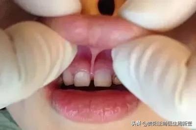 12岁前必须解决的错颌畸形,孩子十二岁牙畸形怎么办