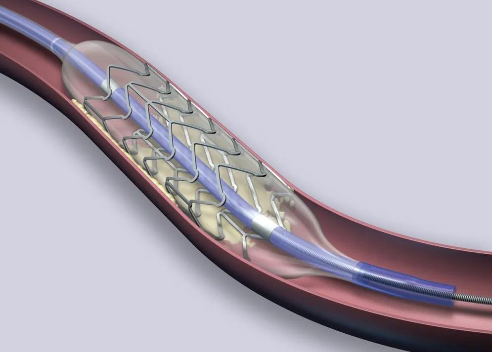 心脏支架植入后是否需要复查造影？这几种情况要分清