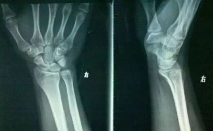 训练完关节响,训练时关节为什么会响