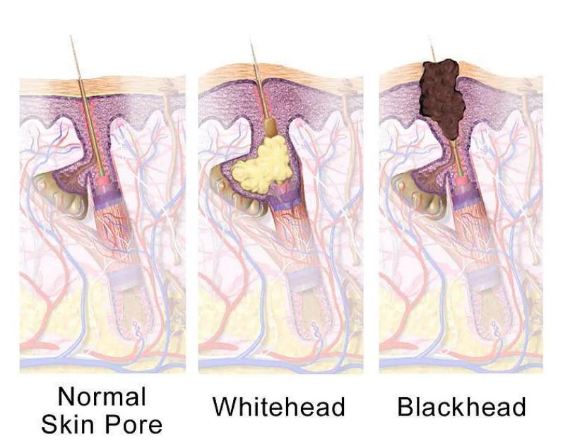 黑头可以用什么方法彻底清除,消除黑头简单有效的方法