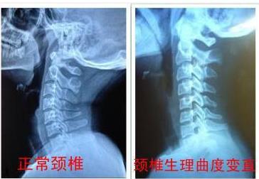 颈椎生理曲度变直反弓,颈椎曲度变直还能好吗