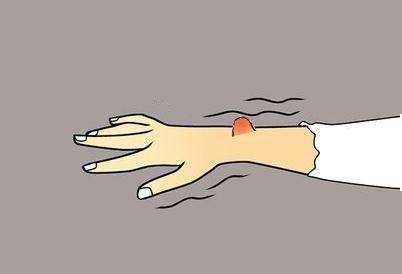 身上长了脂肪瘤要不要手术切了,身上长脂肪瘤是否需要手术治疗