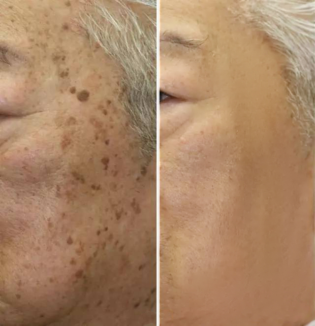 斑怎么保养才能淡,斑的处理方法