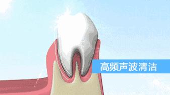 去除牙齿黄垢的神器,牙齿变白除口臭神器