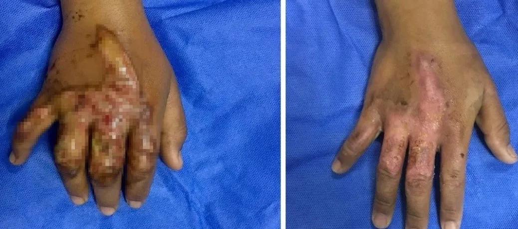 右小腿烧烫伤处理操作视频,老人烧烫伤急救处理方法