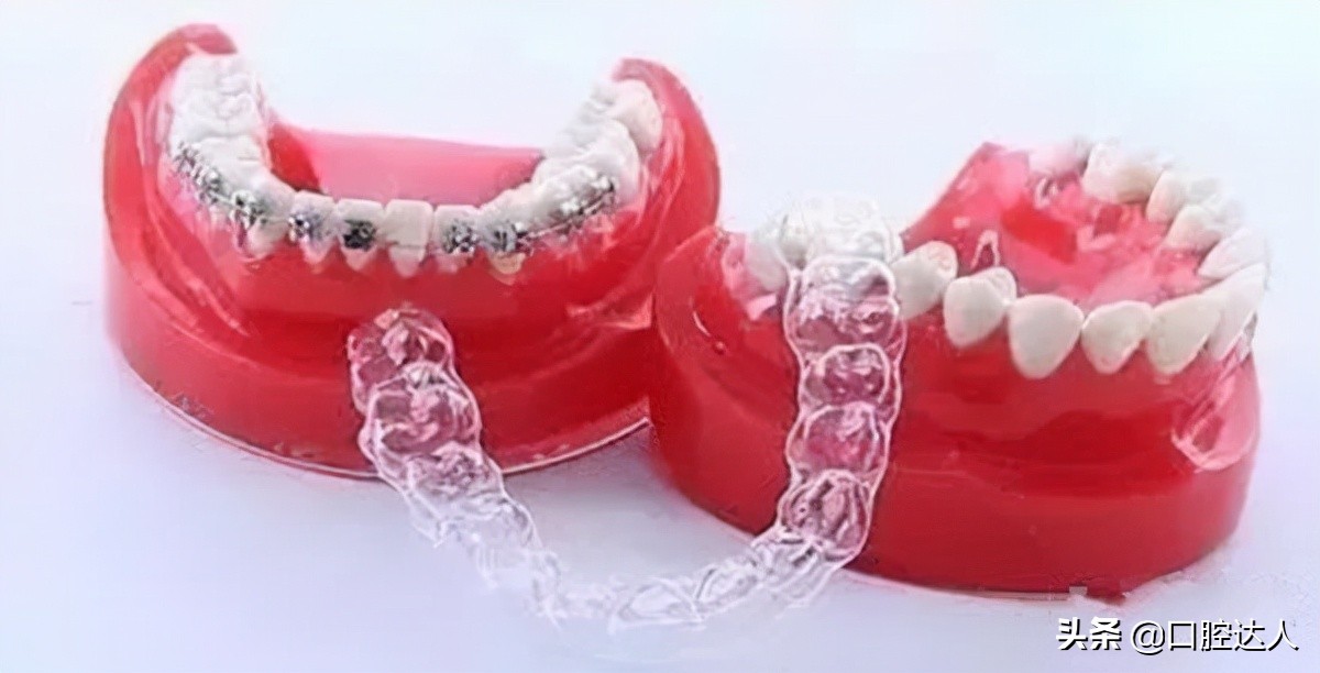 矫正牙后的保持器戴多久,矫牙结束后保持器需要戴多久