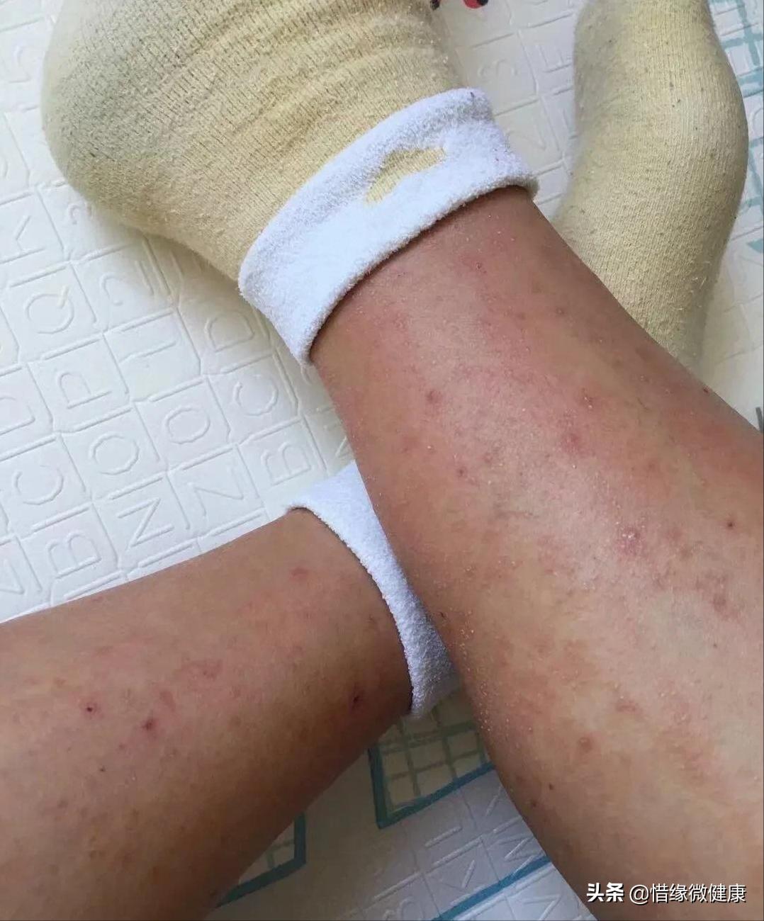 10年湿疹治不好怎么办,10年皮肤病无法根治怎么办