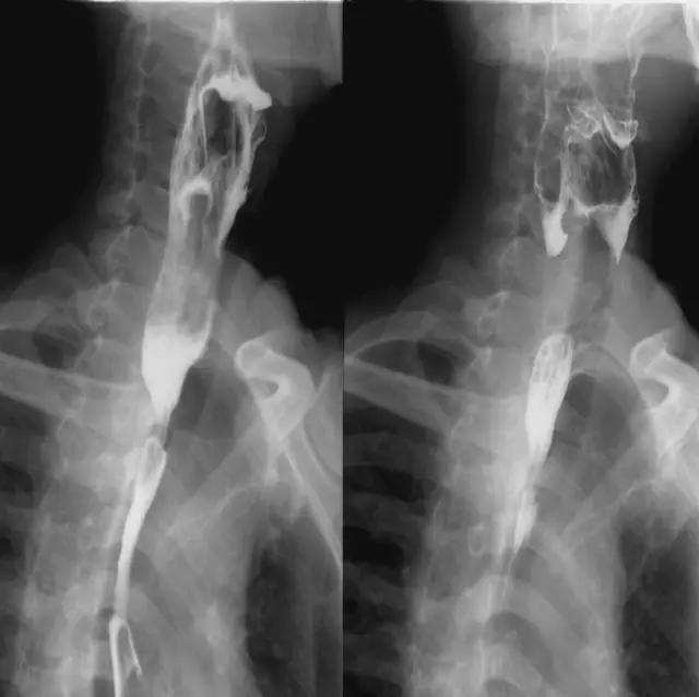 喉部病变做核磁还是ct,耳鼻喉科常见病影像诊断