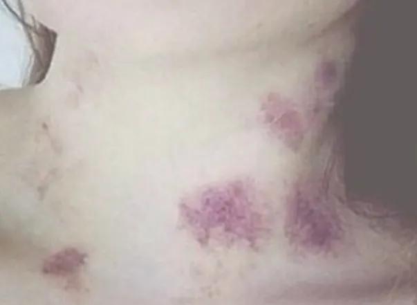 宝妈满脖子“草莓”去接孩子放学,被大娘追问是不是上火