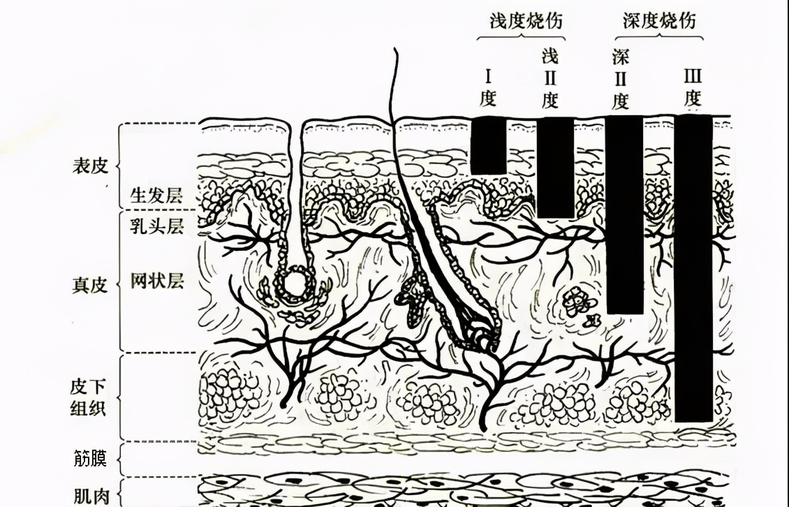 烧烫伤疤痕去除最好办法,烧烫伤疤痕怎么修复