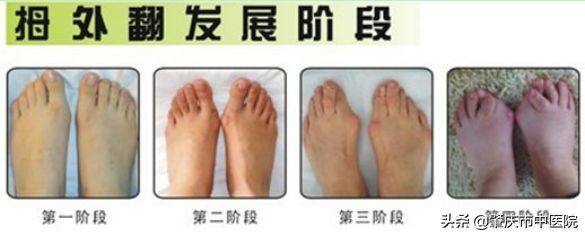 原来脚拇趾外翻是一种病，“元凶”竟是经常穿这种鞋有关！听听市中医院骨伤科专家怎么说……