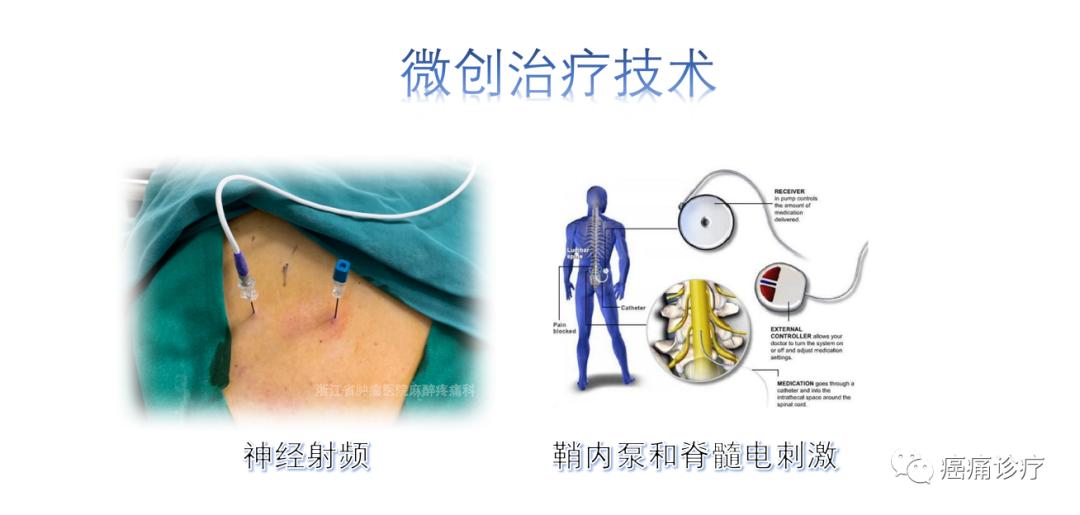 肿瘤引起疼痛治疗方法,肿瘤有缩小为何还是癌痛
