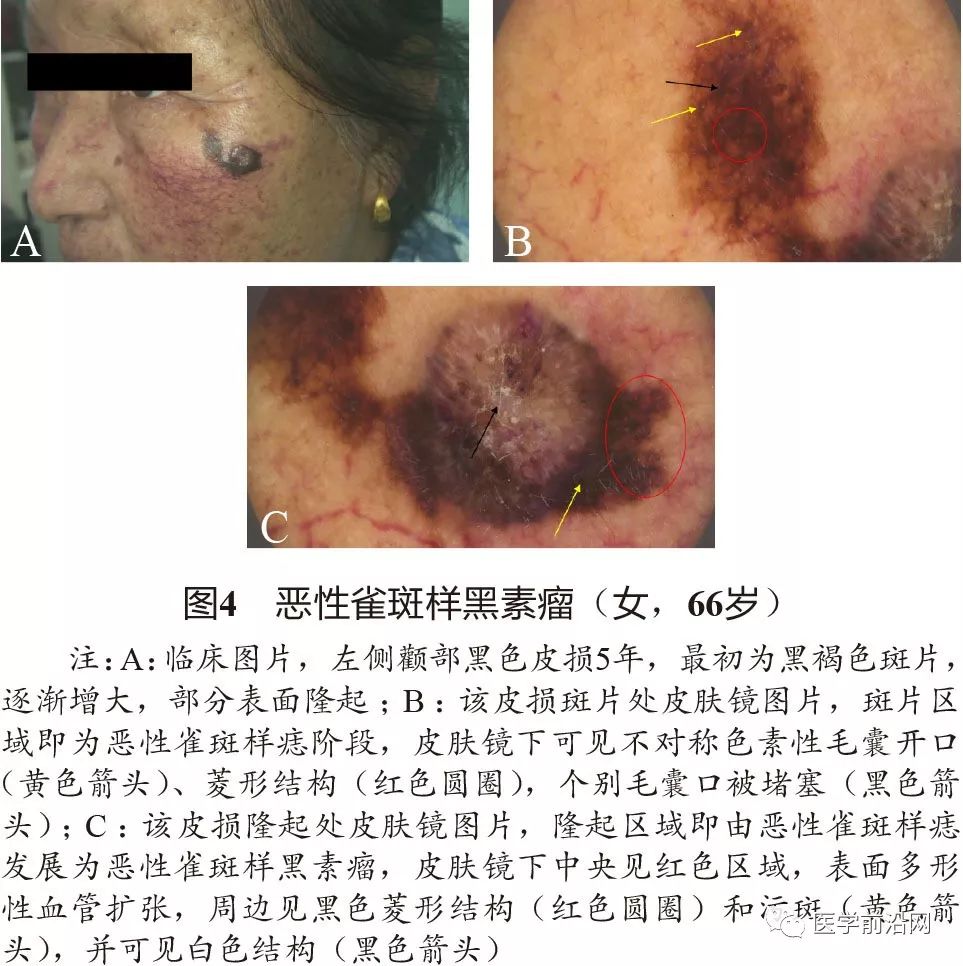 面部常见皮肤病皮肤镜诊断专家共识全文发布